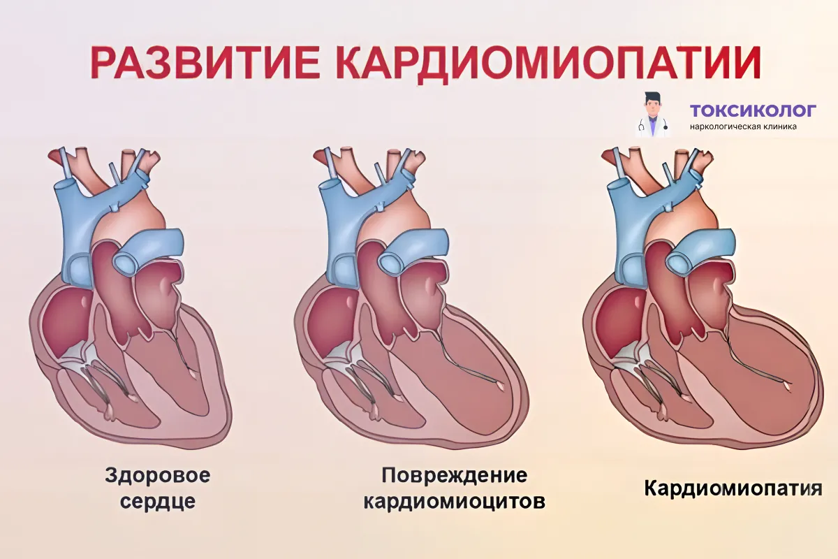 Кардиомиопатия и алкоголь — невидимое разрушение сердца