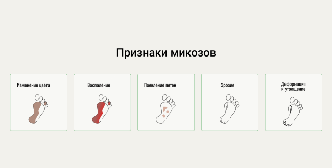Почему чешутся стопы: грибок или просто усталость ног?
