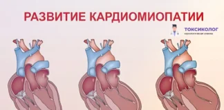 Кардиомиопатия и алкоголь — невидимое разрушение сердца